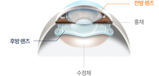 렌즈삽입술 후기 6가지(부작용 이야기 포함)