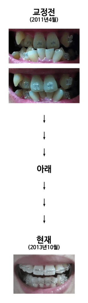 치아교정 후기 6가지 전후 사진 있음