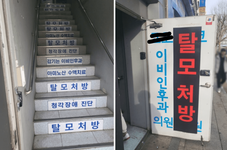 종로 탈모 성지(후기, 가격 포함)